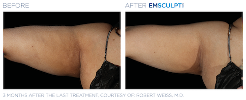 Emsculpt_Neo_PIC_Ba-card-female-arms-080_ENUS100