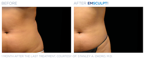 Emsculpt_Neo_PIC_Ba-card-female-lateral-abdomen-127_ENUS100