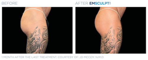Emsculpt_Neo_PIC_Ba-card-male-buttock-088_ENUS100