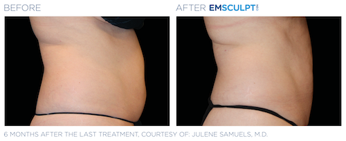 Emsculpt_neo_PIC_Ba-card-female-abdomen-040_ENUS100