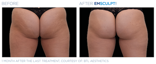 Emsculpt_neo_PIC_Ba-card-female-buttock-061_ENUS100