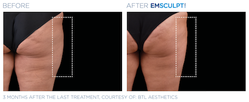 Emsculpt_neo_PIC_Ba-card-female-outer_thighs-059_ENUS100