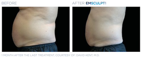 Emsculpt_neo_PIC_Ba-card-male-abdomen-002_ENUS100
